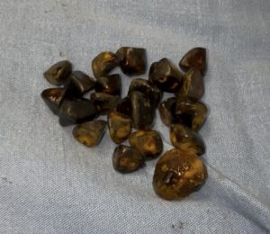 ¿Necesita realmente cirugía de vesícula en Tijuana? Guía clara para pacientes